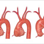 Read more about the article 2014 CCS Thoracic Aortic Disease Guideline Summary