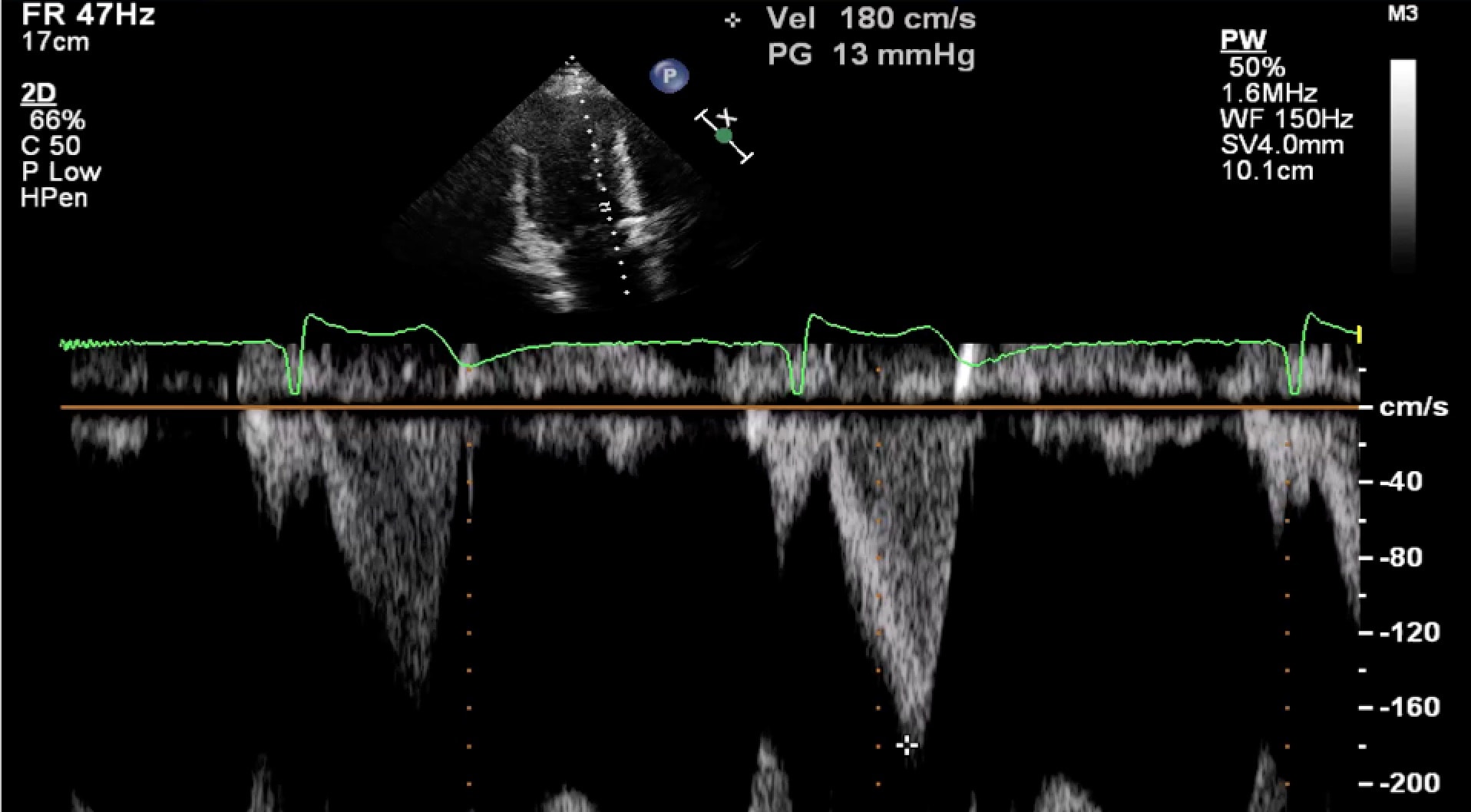 hypertrophic-cardiomyopathy-cardio-guide