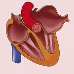 Atrial Abnormality