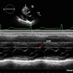 Read more about the article Hypertrophic Cardiomyopathy