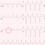 Read more about the article Sgarbossa Criteria