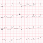 Read more about the article Anterior STEMI with RBBB