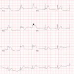 Anterior STEMI with RBBB