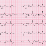 Read more about the article Bidirectional Ventricular Tachycardia