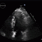 Read more about the article Apical Hypertrophic Cardiomyopathy