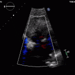 Read more about the article Patent Foramen Ovale
