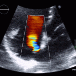 Read more about the article Atrial Septal Defect (ASD)