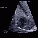 Read more about the article Cardiac Tumours