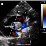 Read more about the article Aortic Coarctation