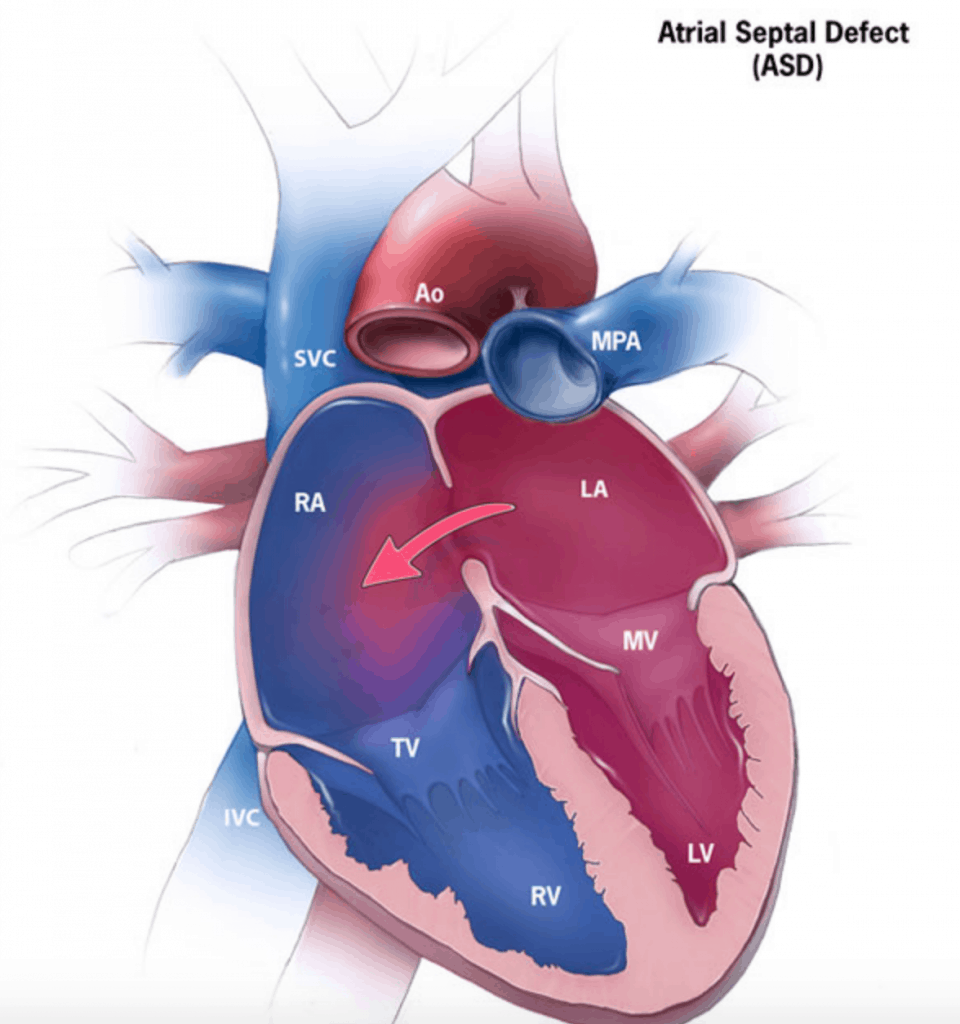 atrial-septal-defect-asd-cardio-guide