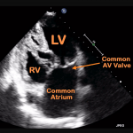 Read more about the article Complete AV Septal Defect