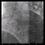 Read more about the article Anomalous Aortic Origin of a Coronary Artery