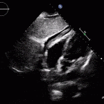 Read more about the article Complications of Myocardial Infarction