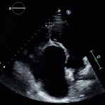 Ebstein’s Malformation