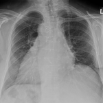 Dextrocardia