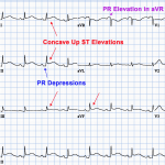 Read more about the article Pericarditis