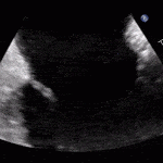 Read more about the article Non-Bacterial Thrombotic Endocarditis (NBTE)