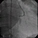 AAOLCx – Anomalous Circumflex (Posterior)