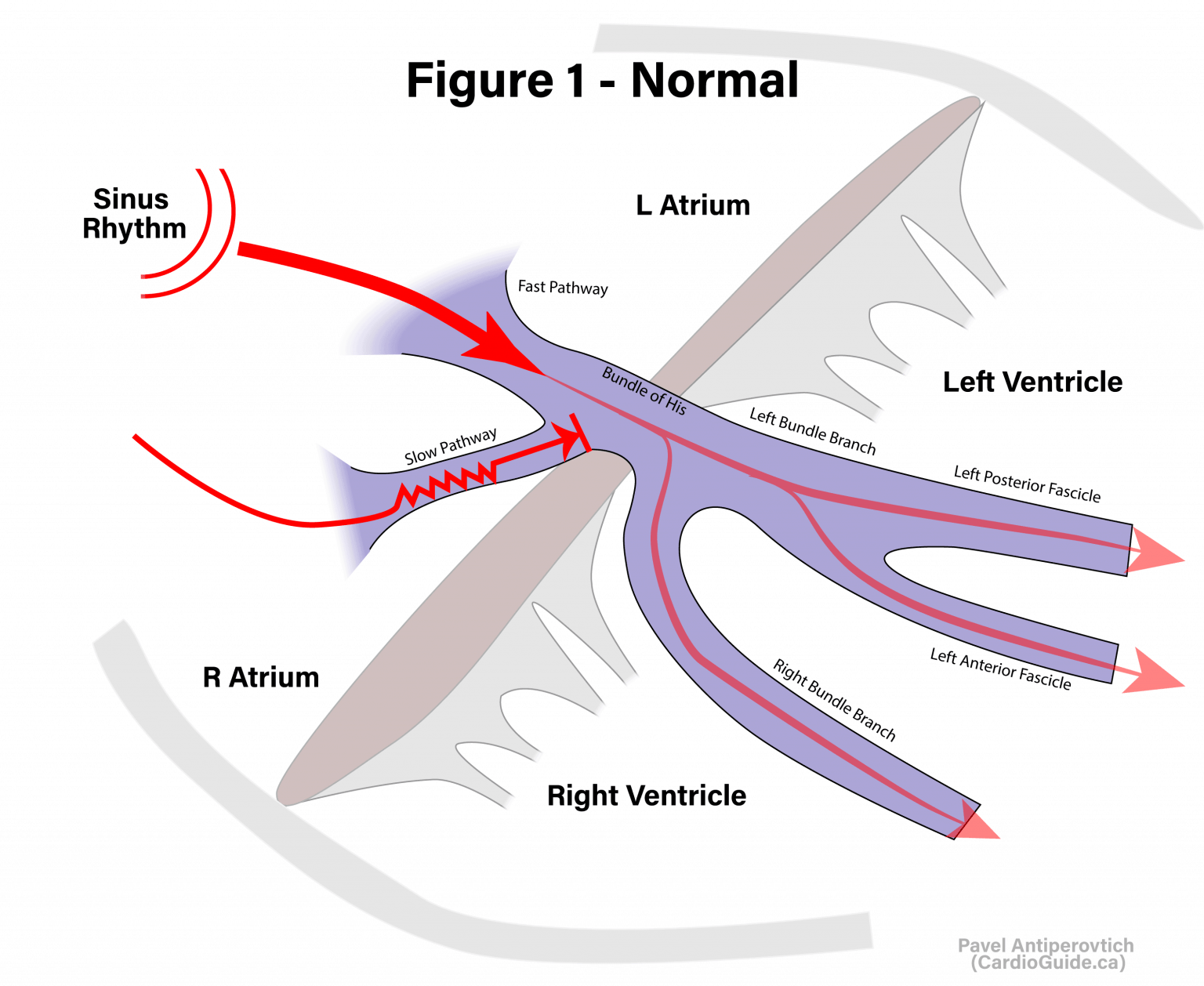 Narrow QRS Tachycardia Cardio Guide