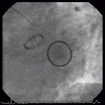 Read more about the article Carbomedic Aortic and Mitral Valve