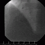 Read more about the article Coronary Spasm