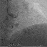 LA Myxoma 2 (Calcified)