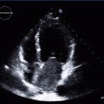 LA Myxoma