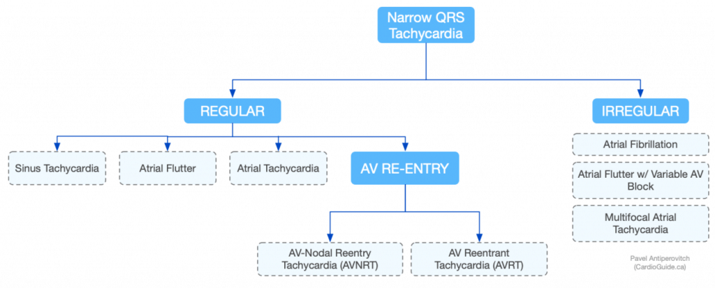 Narrow QRS Tachycardia Approach