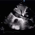 Read more about the article RA IVC Clot