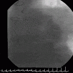 SVG Aneurysm