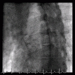 Type A Dissection and Severe AR