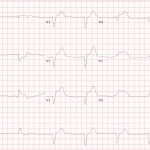 RV Infarct