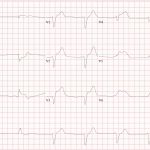 RV Infarct