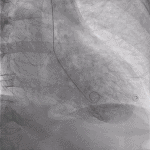 Read more about the article 6 LVgram