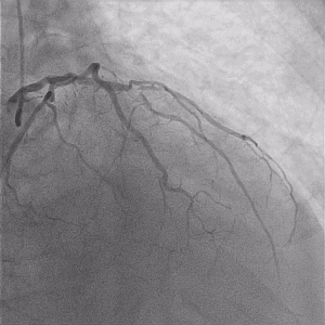 5 RAO Cranial