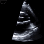 Read more about the article 6 RVF PSAX RVOT