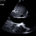 Read more about the article 17 RVF Subcostal IVC Sniff