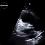 Read more about the article 2 RVF PLAX RVOT
