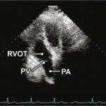 Read more about the article 4 A5C RVOT
