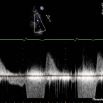 Read more about the article PLAX RVOT CW PR