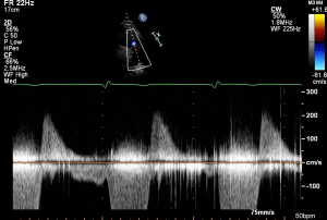 PLAX RVOT CW PR