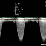 Read more about the article PLAX RVOT CW PS