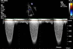 PLAX RVOT CW PS