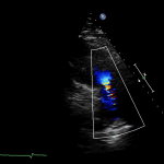 Read more about the article 2 PLAX RVOT Colour