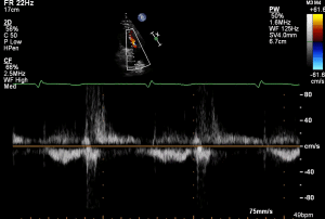 PLAX RVOT PW Sub 1