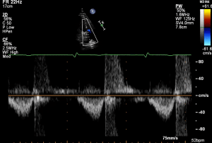 PLAX RVOT PW Sub 2