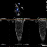 Read more about the article PLAX RVOT PW Valve