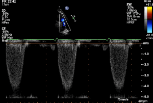 PLAX RVOT PW Valve