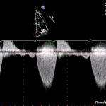 Read more about the article PSAX RVOT CW