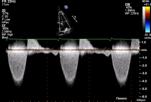 PSAX RVOT CW